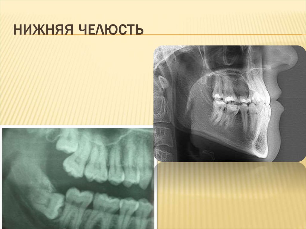 НИЖНЯЯ ЧЕЛЮСТЬ