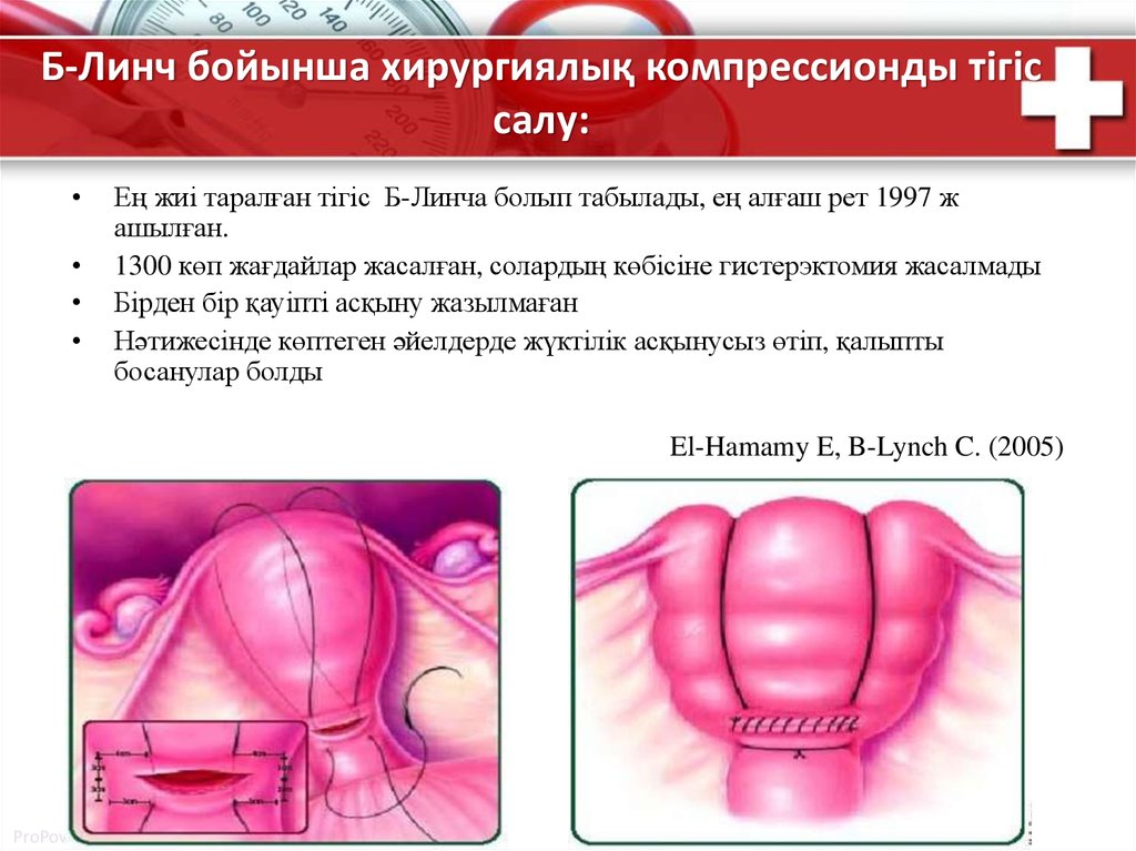 Субтотальная гистерэктомия презентация