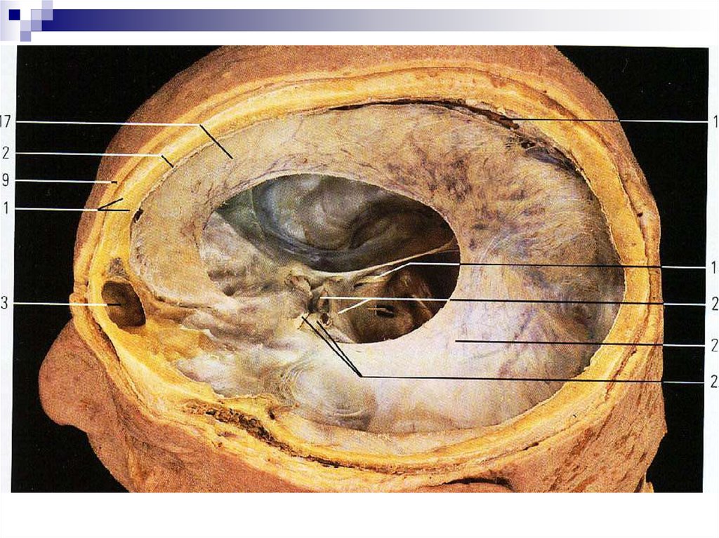 Серп большого мозга. Твердая мозговая оболочка анатомия. Серп большого мозга (твердая оболочка головного мозга). Серп твердой мозговой оболочки. Серп большого мозга на препарате.