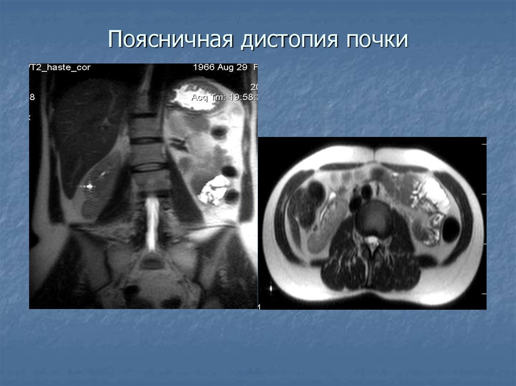 Ультразвуковое исследование органов забрюшинного пространства. Поясничная дистопия почки. Поясничная дистопия почки кт. Поясничная дистопия почки УЗИ.