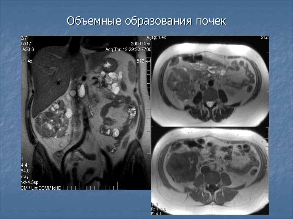 Образование почки. Изоденсное образование в почке что это. Объемные образования почек кт.