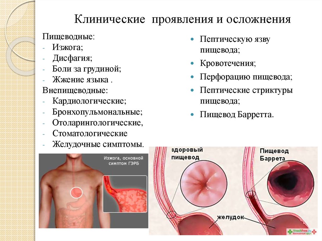 После ковида д. Клинические симптомы ГЭРБ. Внепищеводные симптомы ГЭРБ. Осложнения пищевода Баррета.