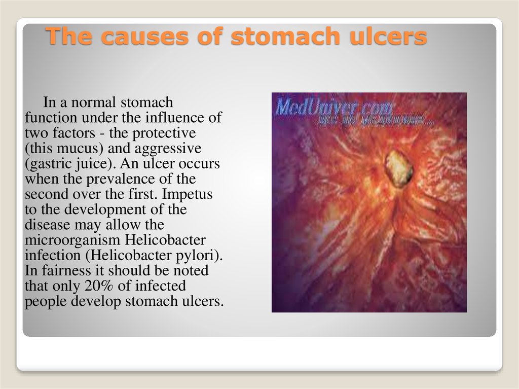The causes of stomach ulcers