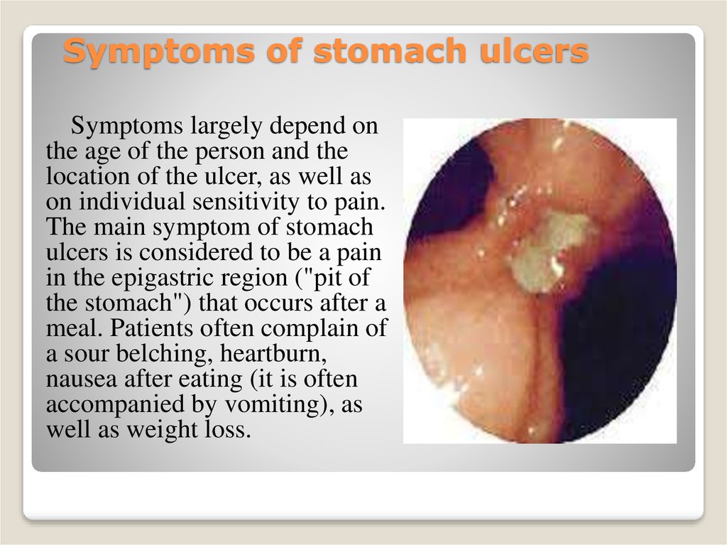 Symptoms of stomach ulcers