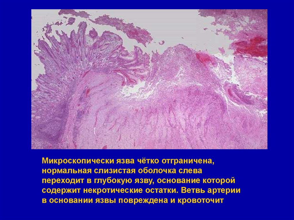 Язва микропрепарат. Язва 12 перстной кишки гистология. Язва желудка патологическая анатомия макропрепарат. Язва желудка патанатомия макропрепарат. Хроническая язва желудка макропрепарат.