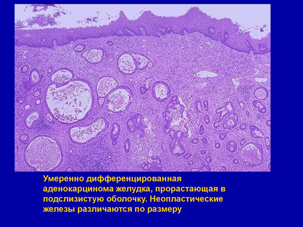 Аденокарцинома желудка. Аденокарцинома желудка микропрепарат. Низкодифференцированная аденокарцинома гистология. Низкодифференцированная аденокарцинома желудка микропрепарат. Аденокарцинома желудка микро.