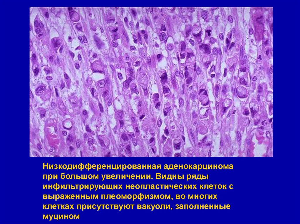 Метастаз рака в лимфатический узел. Эндометриоидная аденокарцинома матки гистология. Низкодифференцированная аденокарцинома гистология. Низкодифференцированная аденокарцинома легкого гистология. Аденокарцинома желудка гистология.