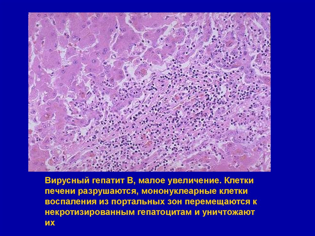 Клетки печени разрушаются. Мононуклеарные клетки гистология. Клетки печени Малое увеличение. Ретикулоэндотелиальные клетки в печени микропрепарат. Мононуклеарные клетки печени.