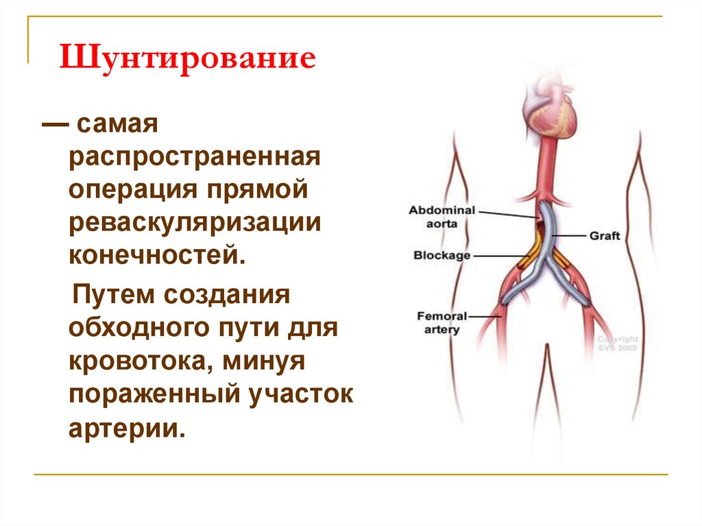 Операция на сосудах нижних конечностей. Шунтирование сосудов нижних конечностей. Шунтирование артериального сосуда.