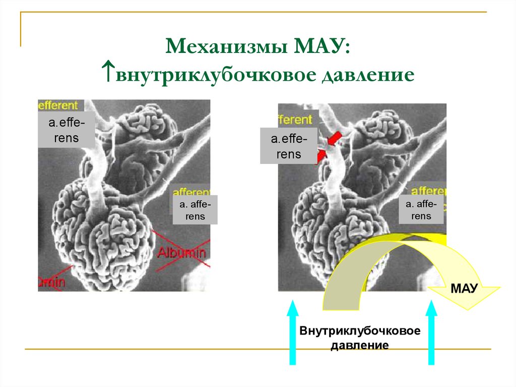 Механизмы МАУ: внутриклубочковое давление
