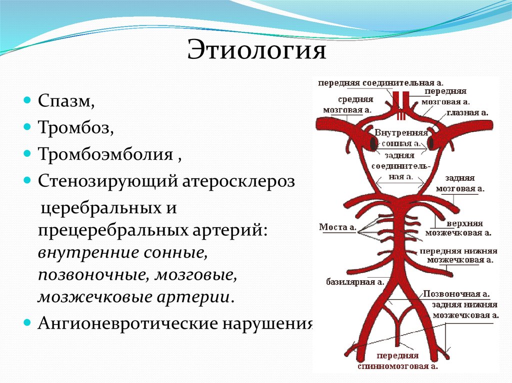 Тромбоз артерии мозга