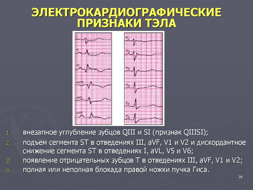 Экг при тэла фото