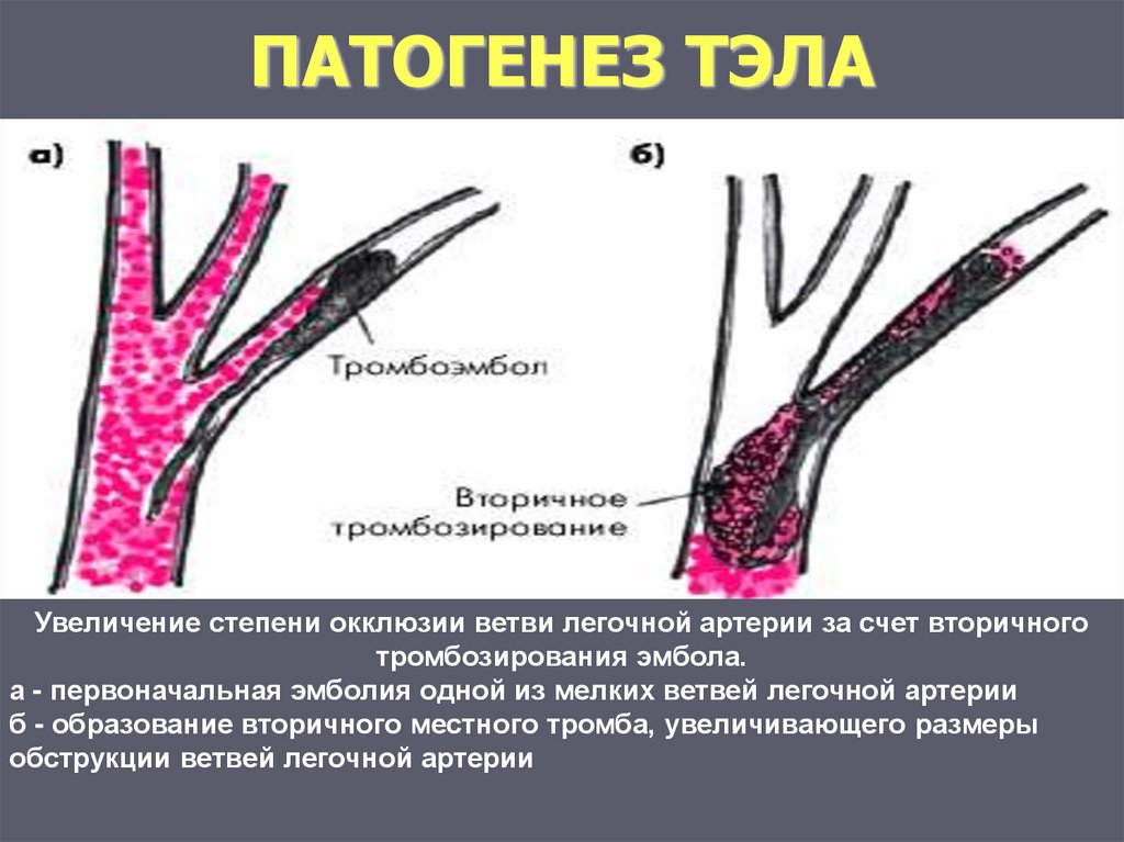 Тромбозы и эмболии артерий. Тромбоэмболия легочной артерии этиология. Тромбоэмболия легочной артерии механизм развития. Тэла механизм развития.