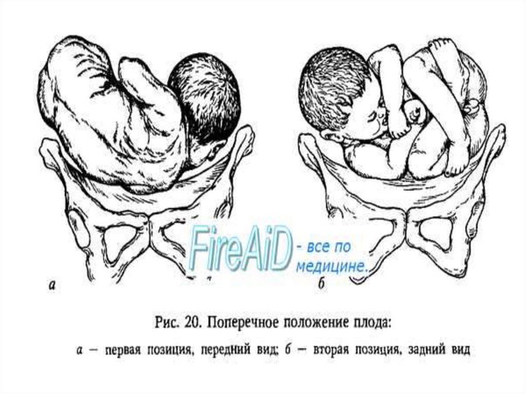 Поперечное положение. Положение плода продольное позиция 2 вид передний. Поперечное положение плода позиция. Поперечное положение плода 1 позиция. Поперечное положение плода 2 позиция.