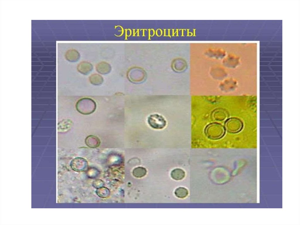 Эритроциты в моче картинки