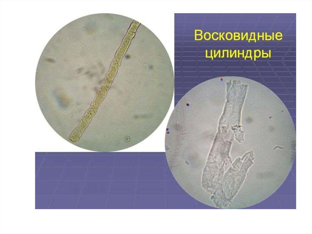 Цилиндры в моче. Микроскопия мочи гиалиновые цилиндры. Цилиндры в осадке мочи.