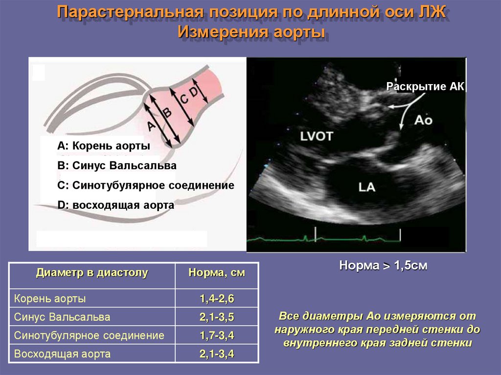 Эхо левого желудочка. Аортальный клапан норма ЭХОКГ сердца. Парастернальная позиция в ЭХОКГ. Парастернальная позиция по длинной оси на ЭХОКГ. Измерение корня аорты на ЭХОКГ.