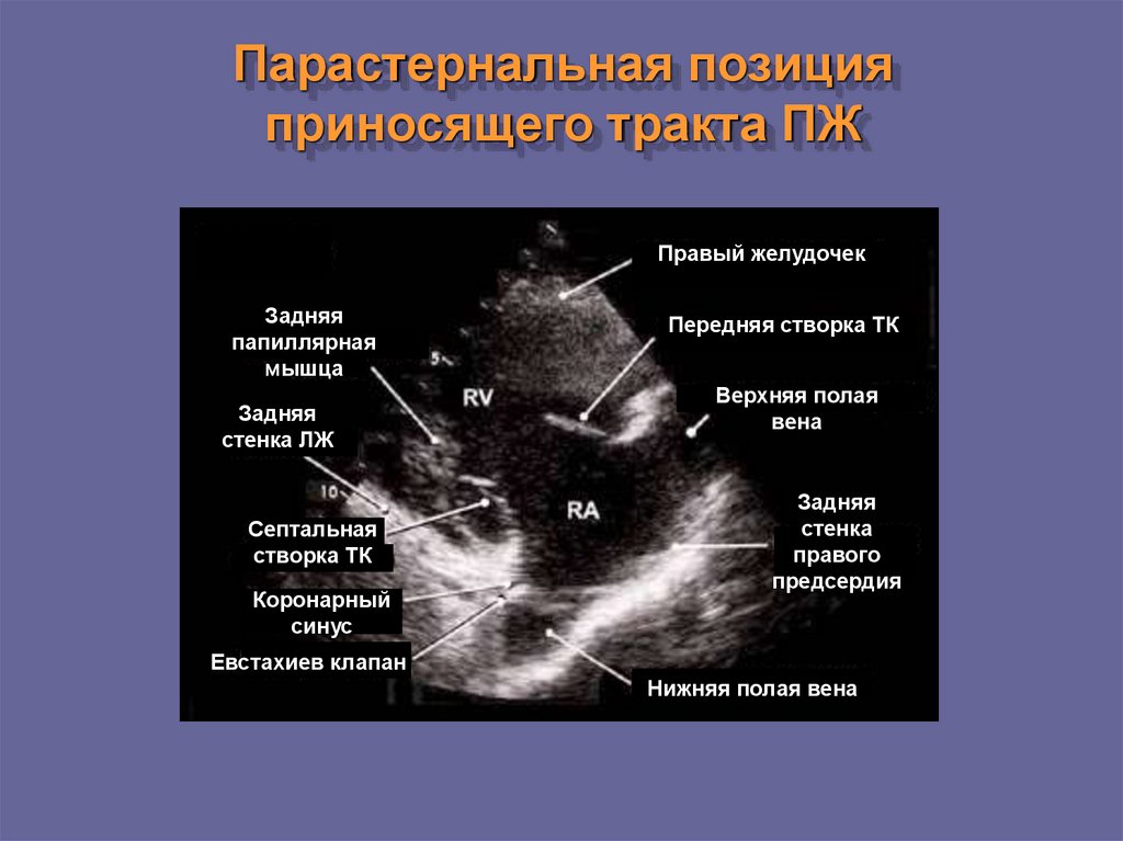 Парастернальная линия это