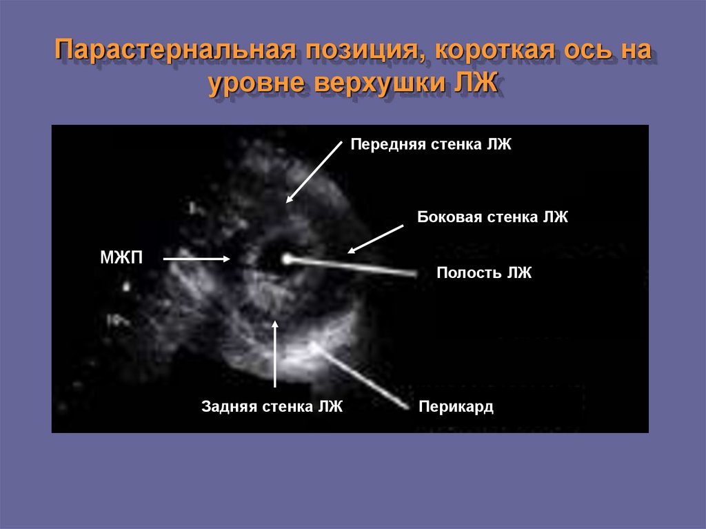 Гиперэхогенный фокус. Парастернальная позиция по короткой оси на уровне верхушки лж. УЗИ сердца парастернальная позиция короткая ось. Парастернальная позиция по короткой оси на уровне верхушки сердца. ЭХОКГ парастернальная позиция по короткой оси.