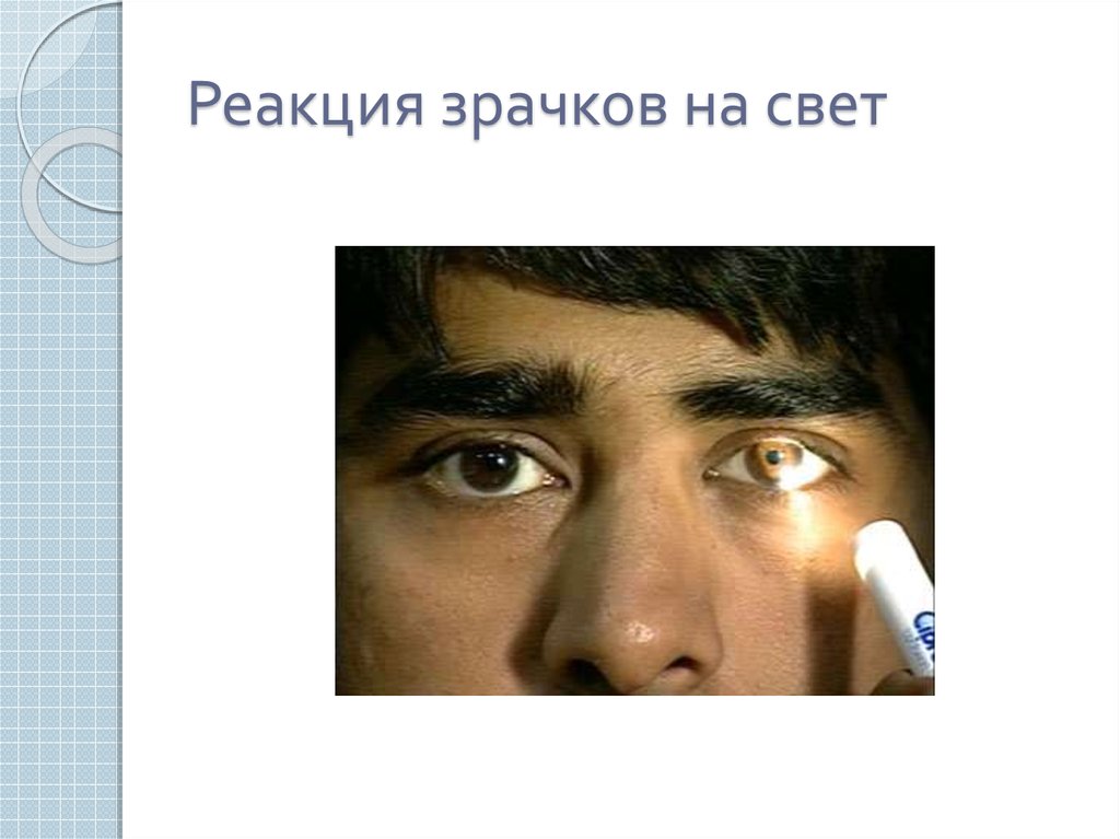 Реакция зрачков на свет. Исследование реакции зрачков на свет. Реакция зрачков на свет в норме. Прямая и содружественная реакция зрачков на свет.