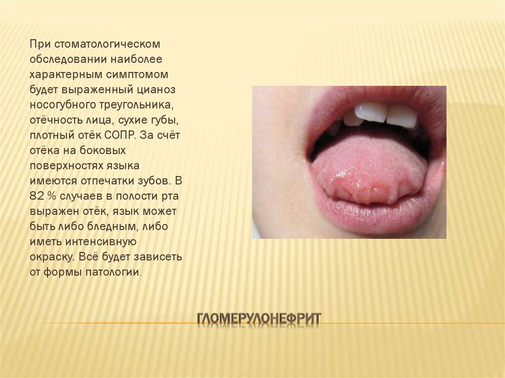Изменения в полости рта при заболеваниях почек - презентация онлайн