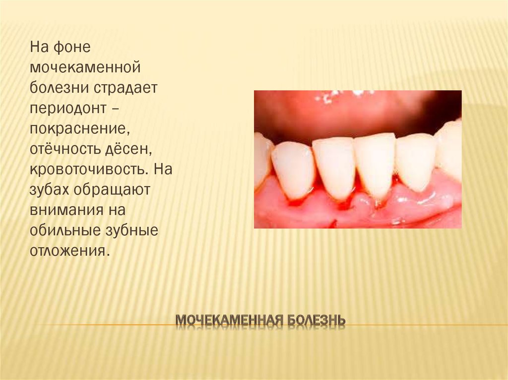 Мочекаменная болезнь