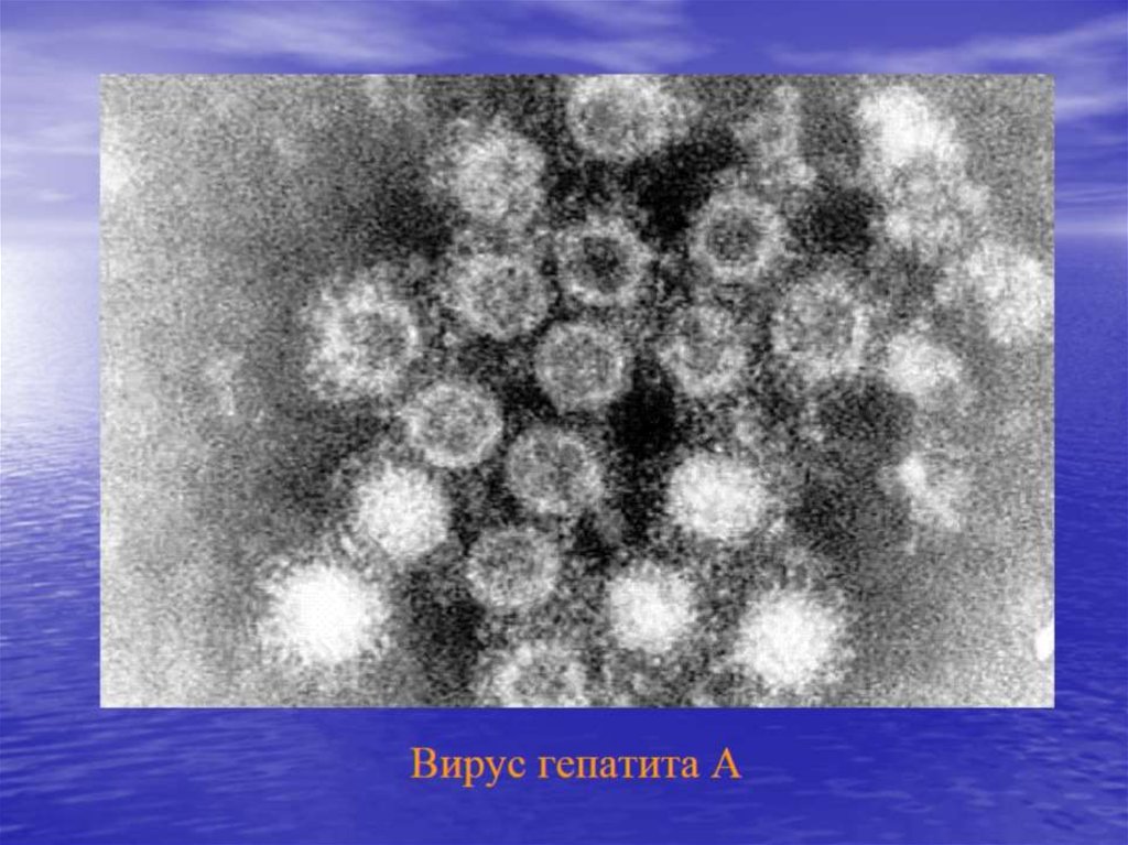Вирусы вызывающие гепатит. Иммунная электронная микроскопия гепатита. Вирус гепатита микрофотография. Гепатит а электронная микроскопия. Вирус гепатита под микроскопом.