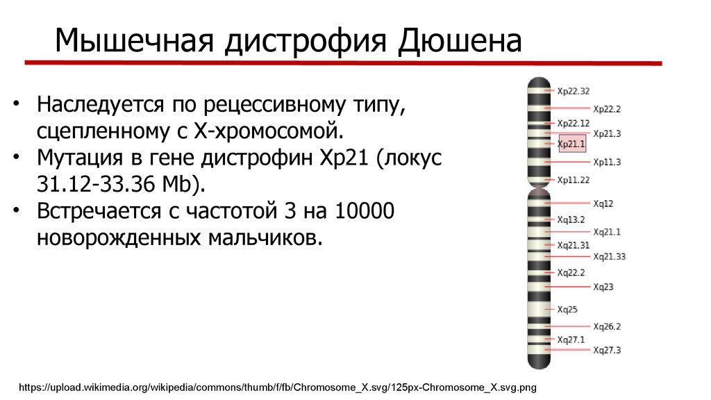 Миодистрофия дюшенна презентация