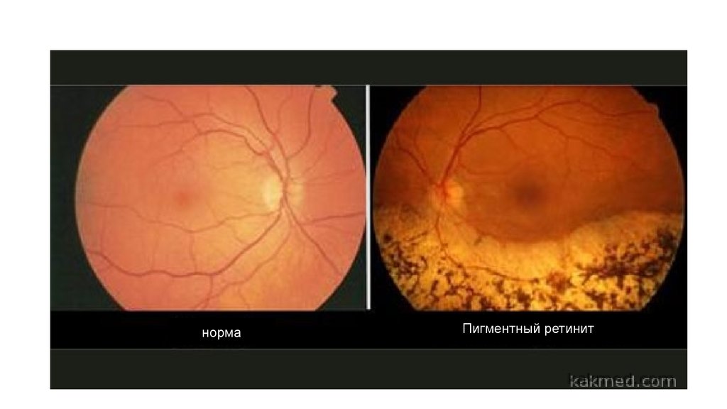 Пигментный ретинит презентация