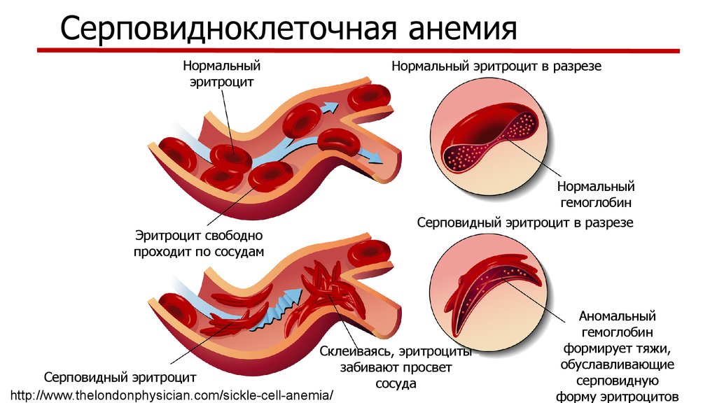 Серповидно клеточная анемия картинки