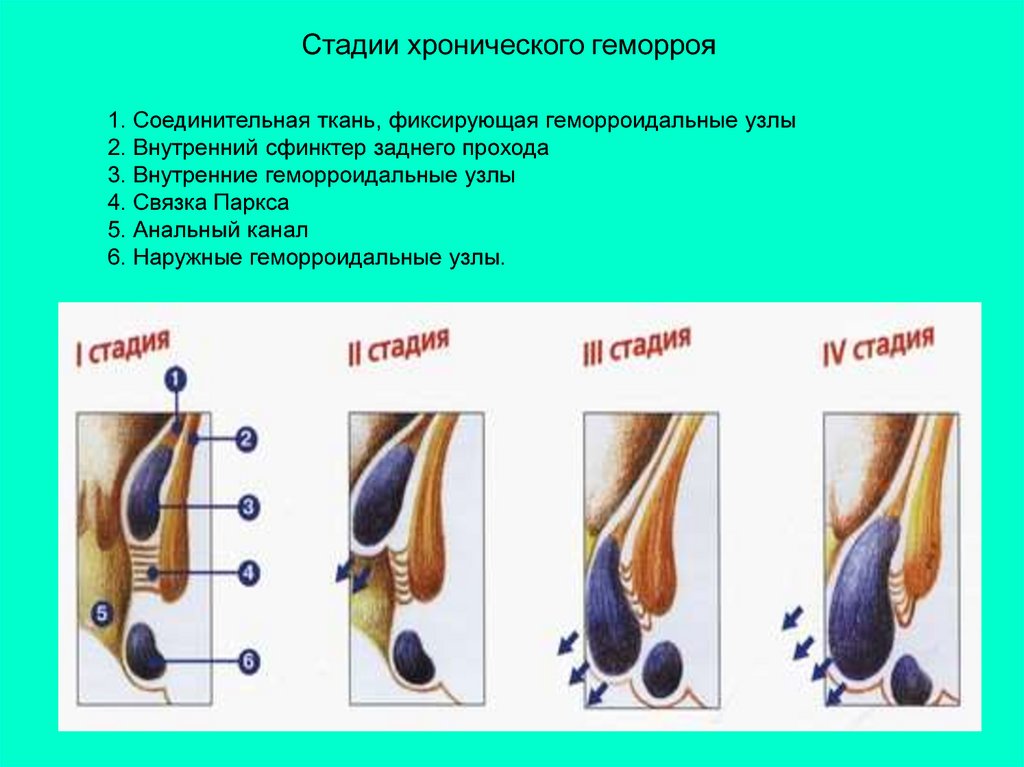 Схема лечения наружного геморроя у мужчин