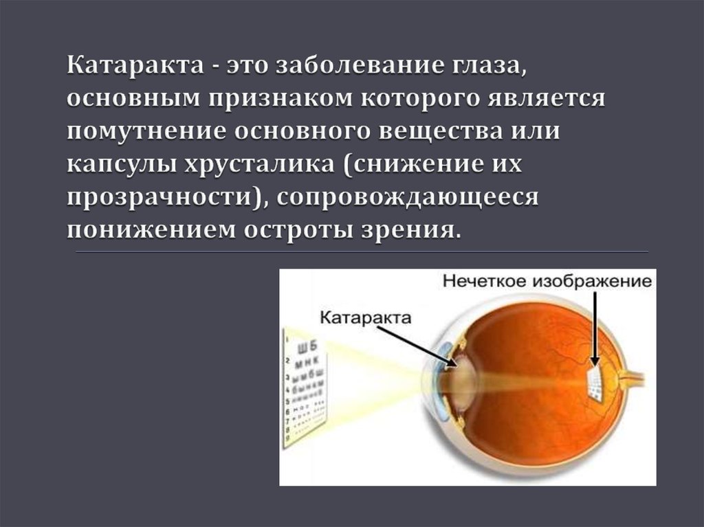 Признаки больных глаз. Катаракта хрусталика глаза. Симптомы катаракты глаза.