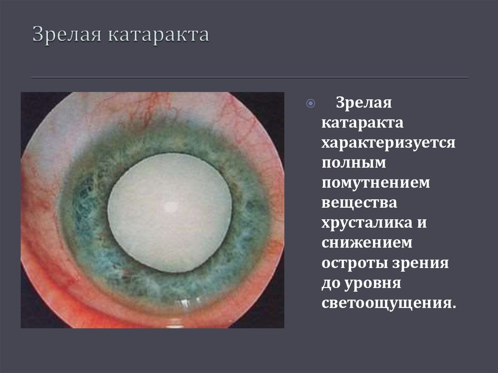 Начальная старческая катаракта