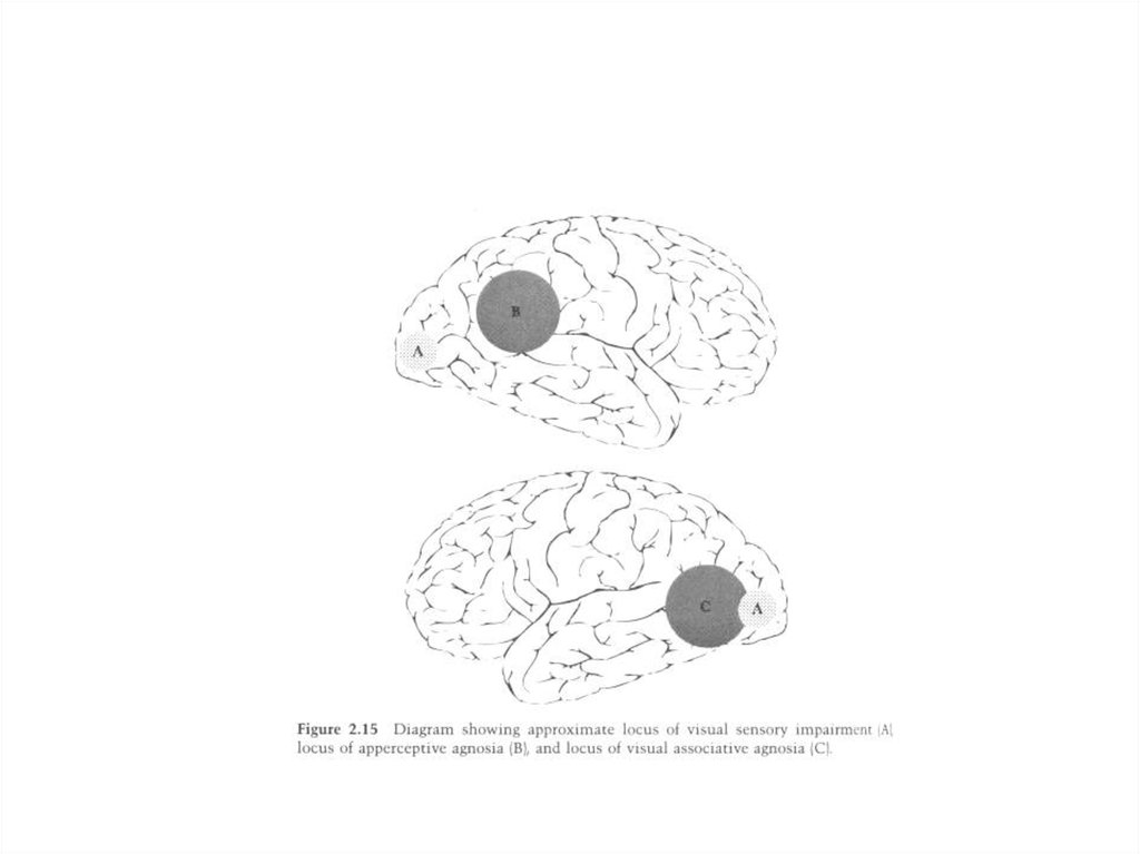Вид агнозии характеризующийся нарушением узнавания предметов или их изображений