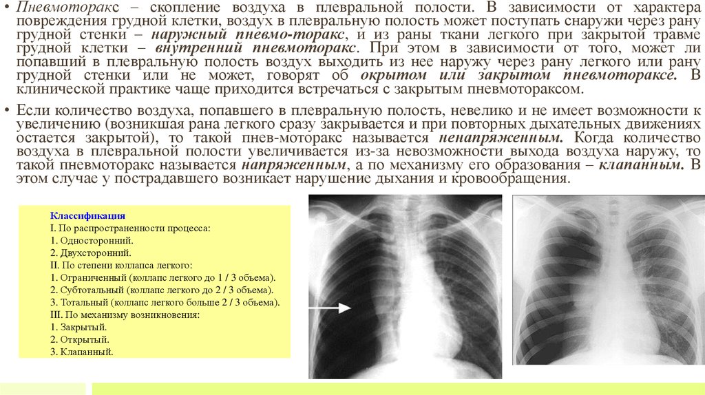 Коллапс легкого это. Пневмоторакс рентген симптомы. Пневмоторакс рентген описание. Закрытый пневмоторакс рентген с описанием. Пневмоторакс рентген заключение.