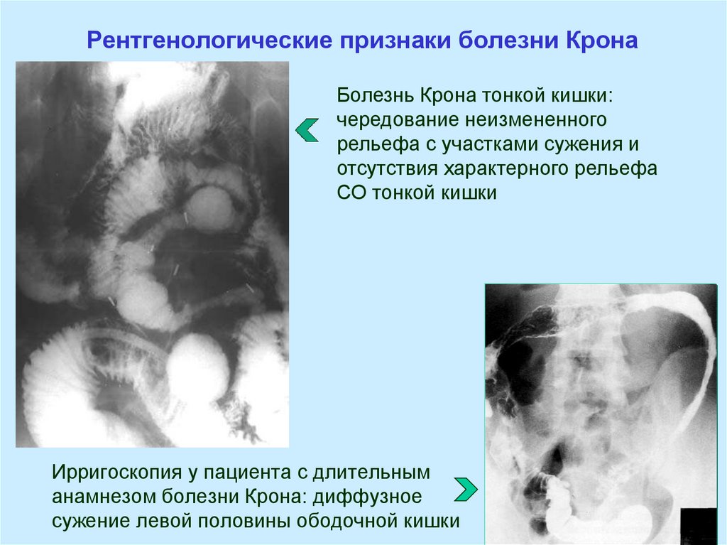 Рентгенологические признаки болезни Крона