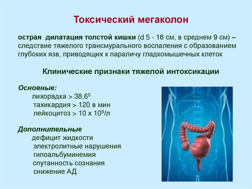 Идиопатический мегаколон по утвержденным клиническим рекомендациям 2021. Токсический мегаколон. Функциональный мегаколон. Токсический мегаколон при язвенном колите. Мегаколон токсический клинические рекомендации.