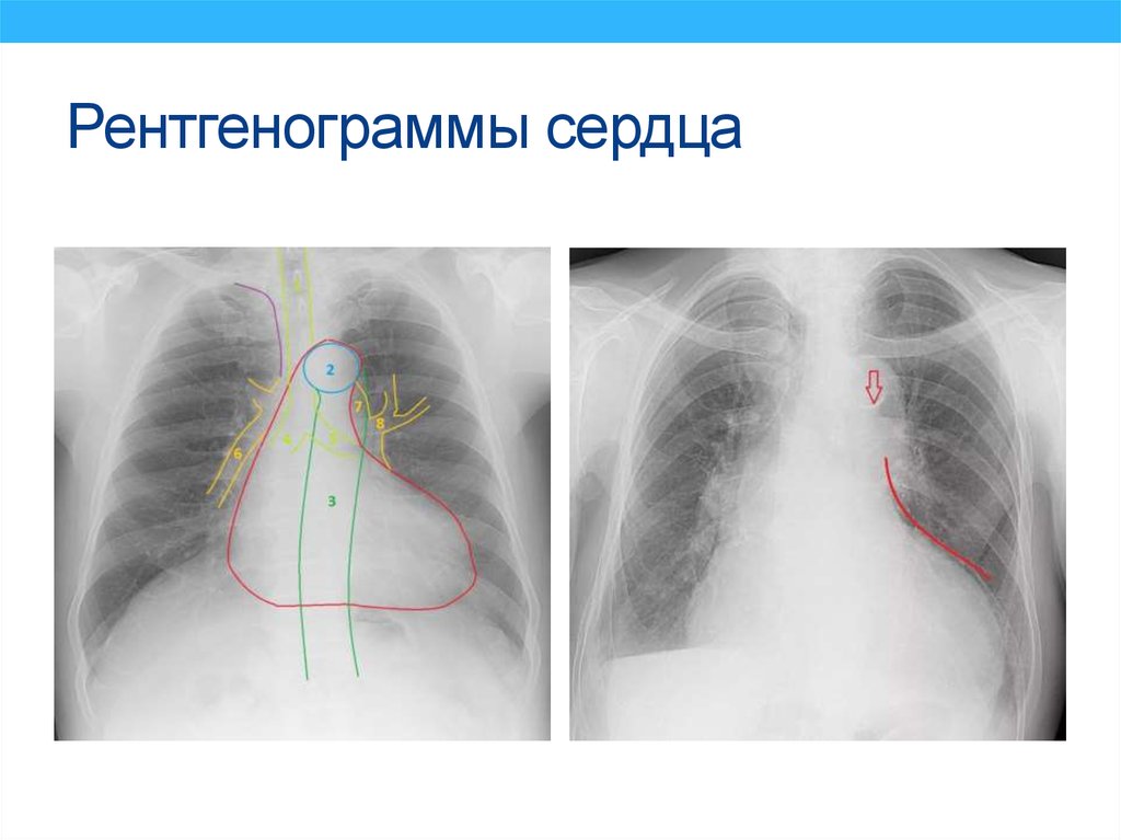 Рентген сердца