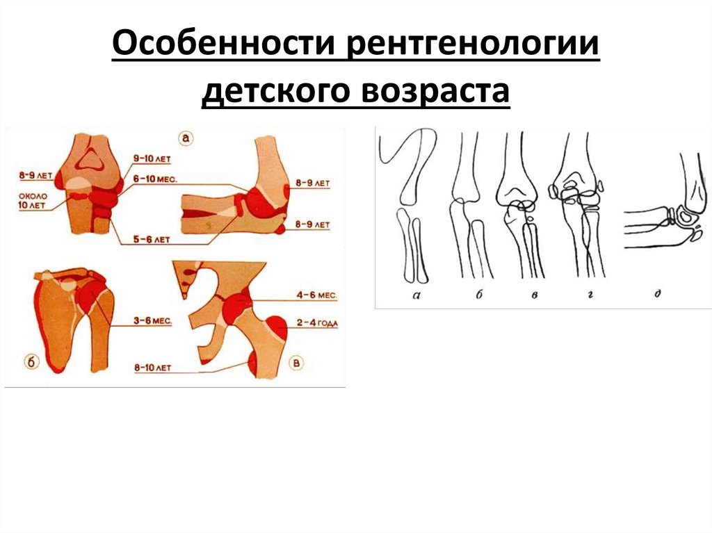 Особенности переломов костей