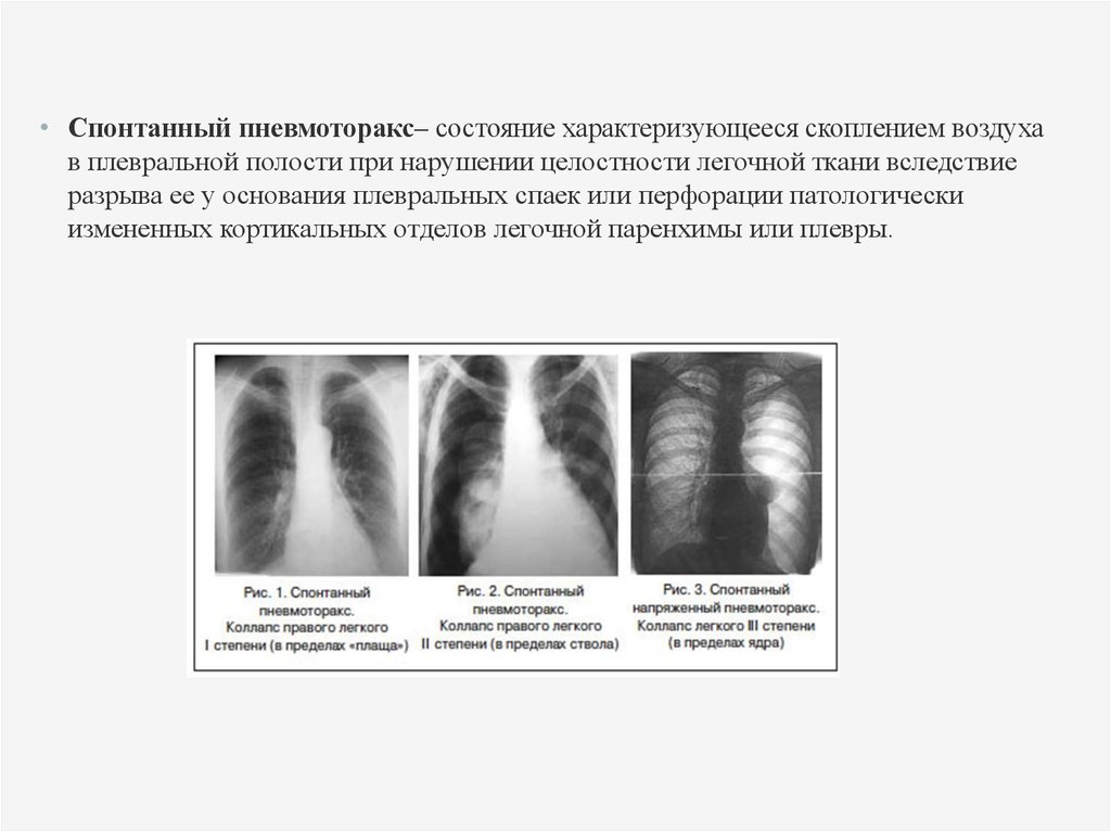 Спонтанный пневмоторакс карта смп