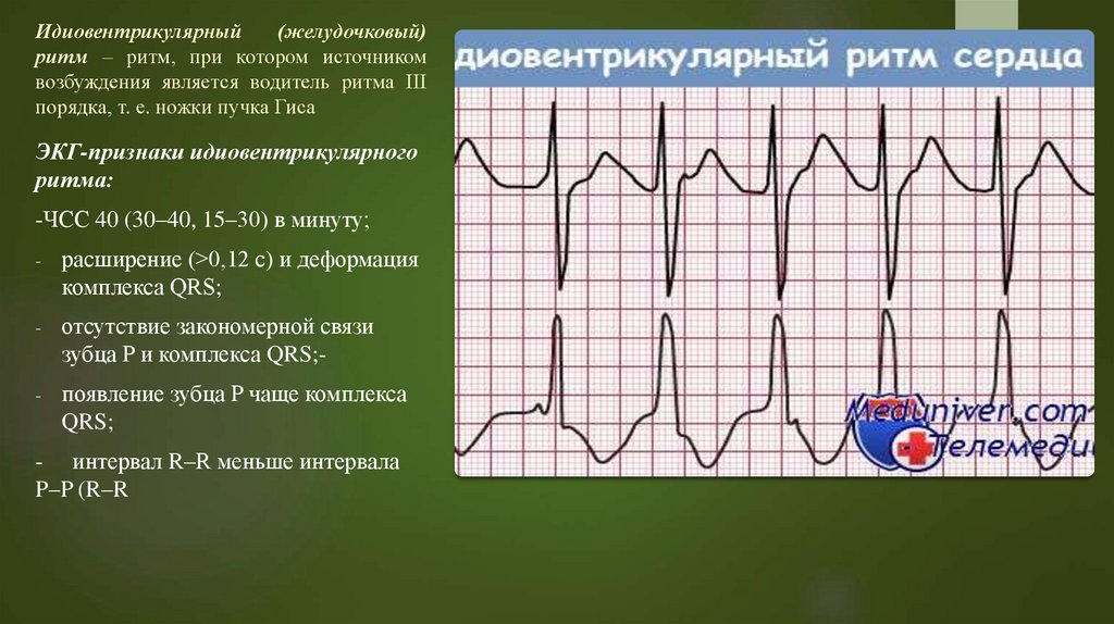 Желудочковый ритм. Желудочковый водитель ритма ЭКГ. Ускоренный желудочковый ритм на ЭКГ. Идиовентрикулярный желудочковый ритм. Ускоренный желудочковый ритм ЧСС.