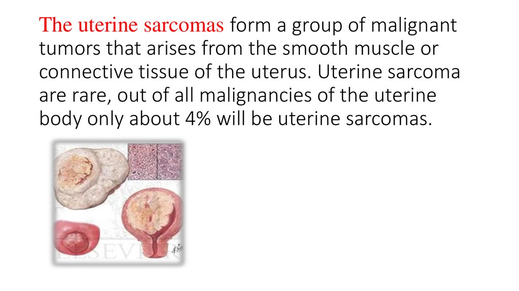 The uterine sarcomas form a group of malignant tumors that arises from the smooth muscle or connective tissue of the uterus.