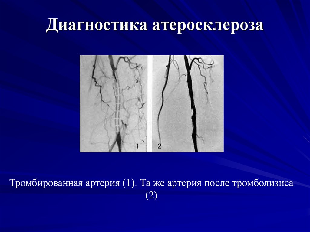 Церебральный атеросклероз карта вызова