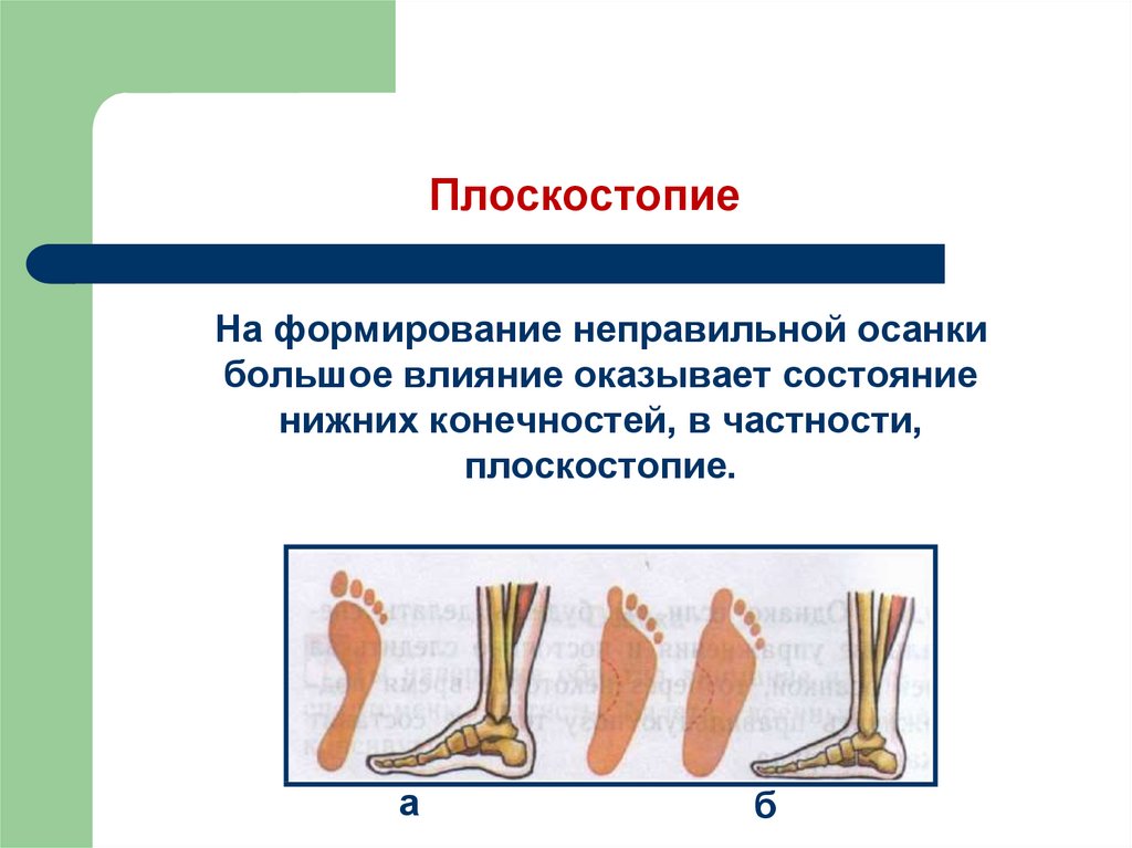 Нарушение осанки и плоскостопие презентация 8 класс биология