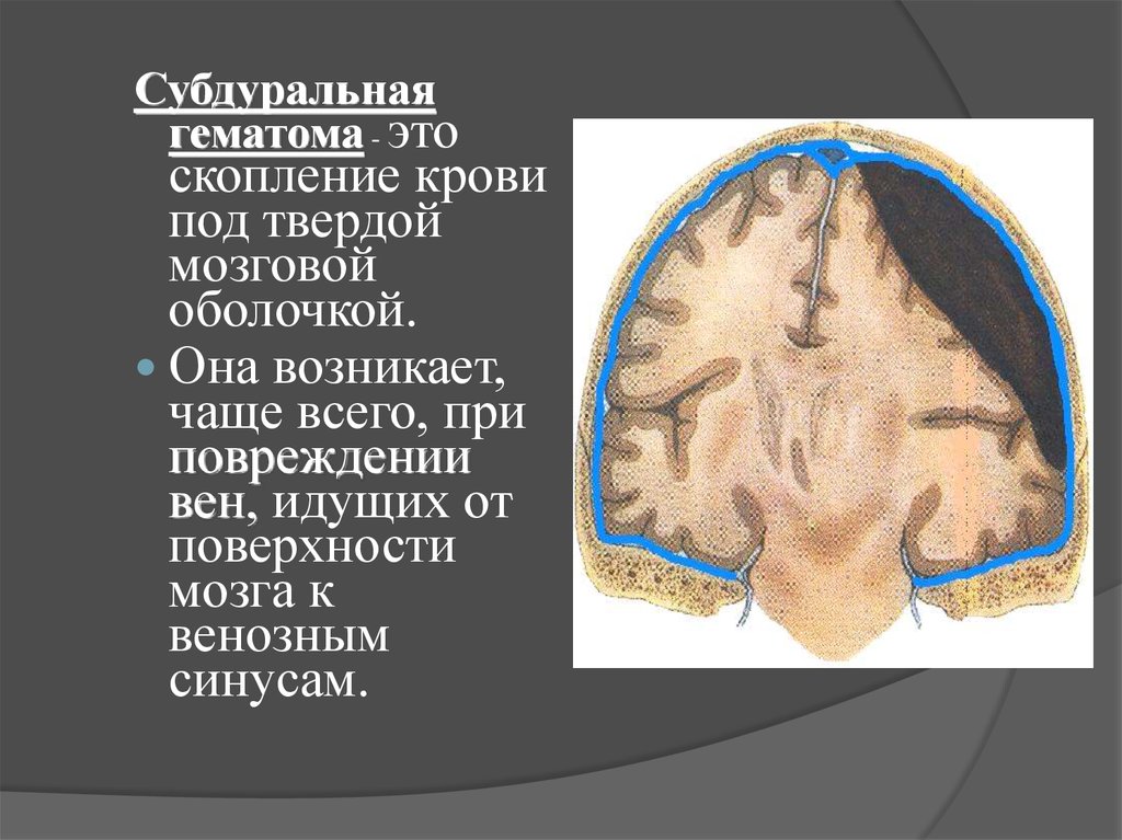 Субдуральная гематома. Субдуральная гематома черепа. Субдуральная гематома 10мл. Пластинчатая субдуральная гематома. Субдуральная гематома классификация.