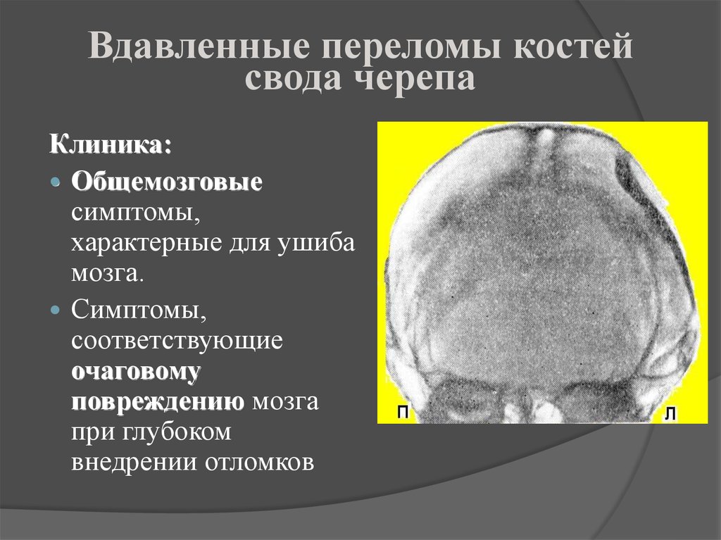 Ушиб свода черепа. Классификация переломов костей свода черепа. Дырчатый перелом свода черепа. ЧМТ перелом свода черепа. Перелом костей свода и основания черепа.