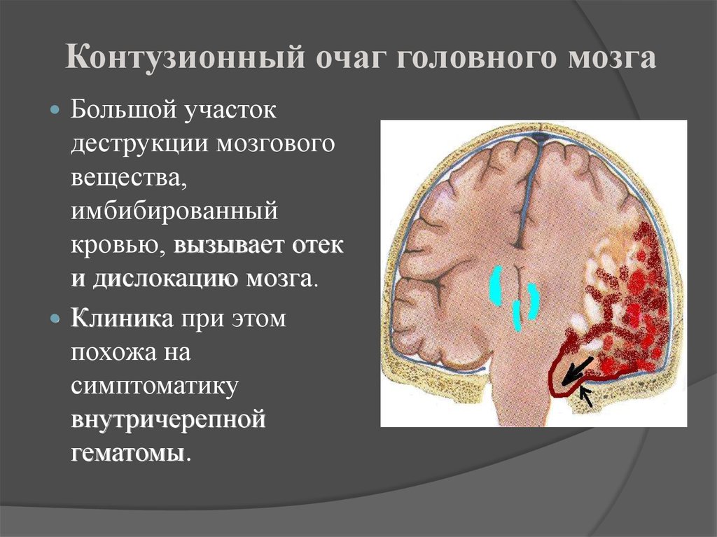 Мелкие очаги в головном мозге