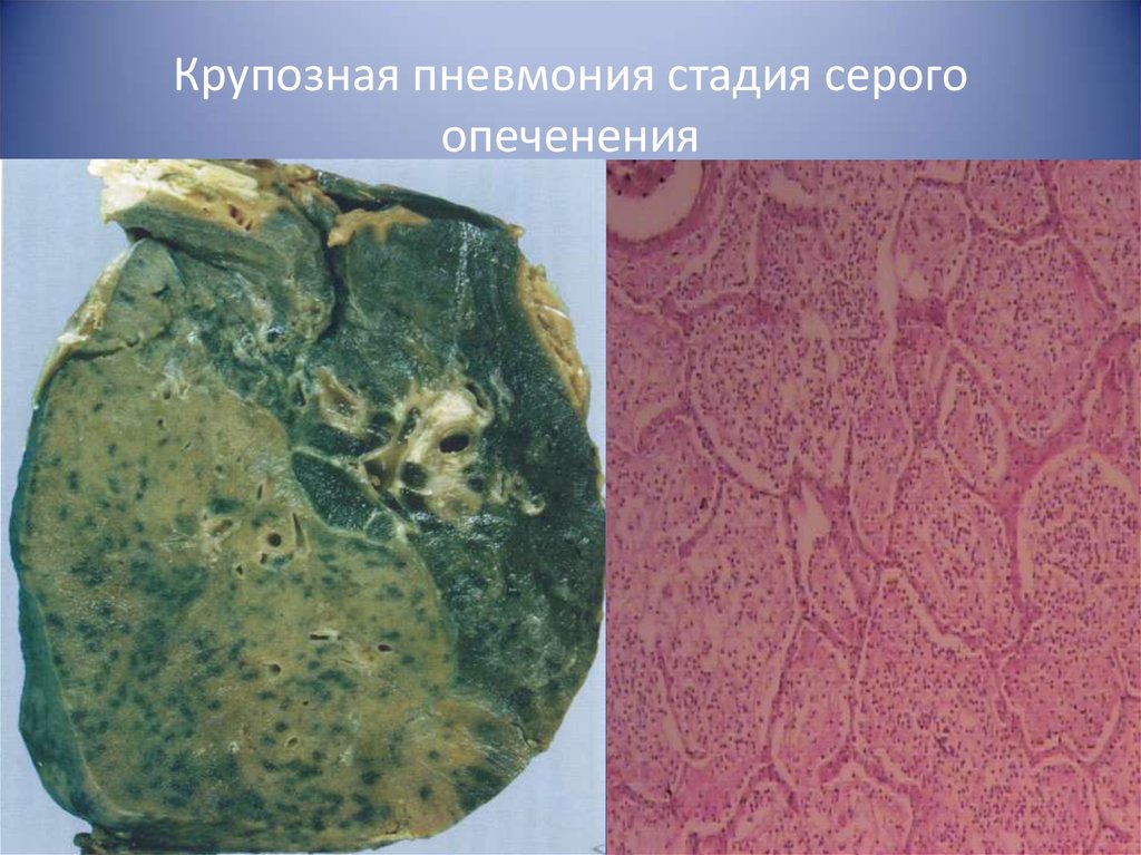 Крупозная пневмония. Долевая пневмония в стадии серого опеченения макропрепарат. Крупная пневмония макропрепаратпрепарат. Серое опеченение крупозной пневмонии. Макропрепарат крупозная пневмония серое опеченение.