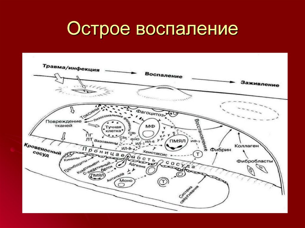 Воспаление 2. Виды острого воспаления. Схема острого воспаления. Исходы острого воспаления патфиз.