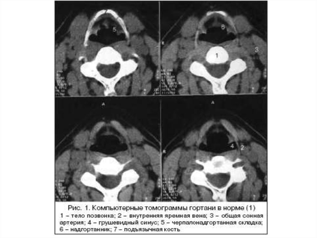 Гортань кт анатомия. Грушевидный синус кт анатомия. Подъязычная кость кт анатомия. Кт анатомия гортани норма.